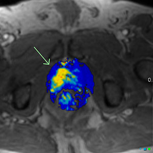 Case courtesy of Dr Chris O'Donnell, Radiopaedia.org. From the case rID: 19238